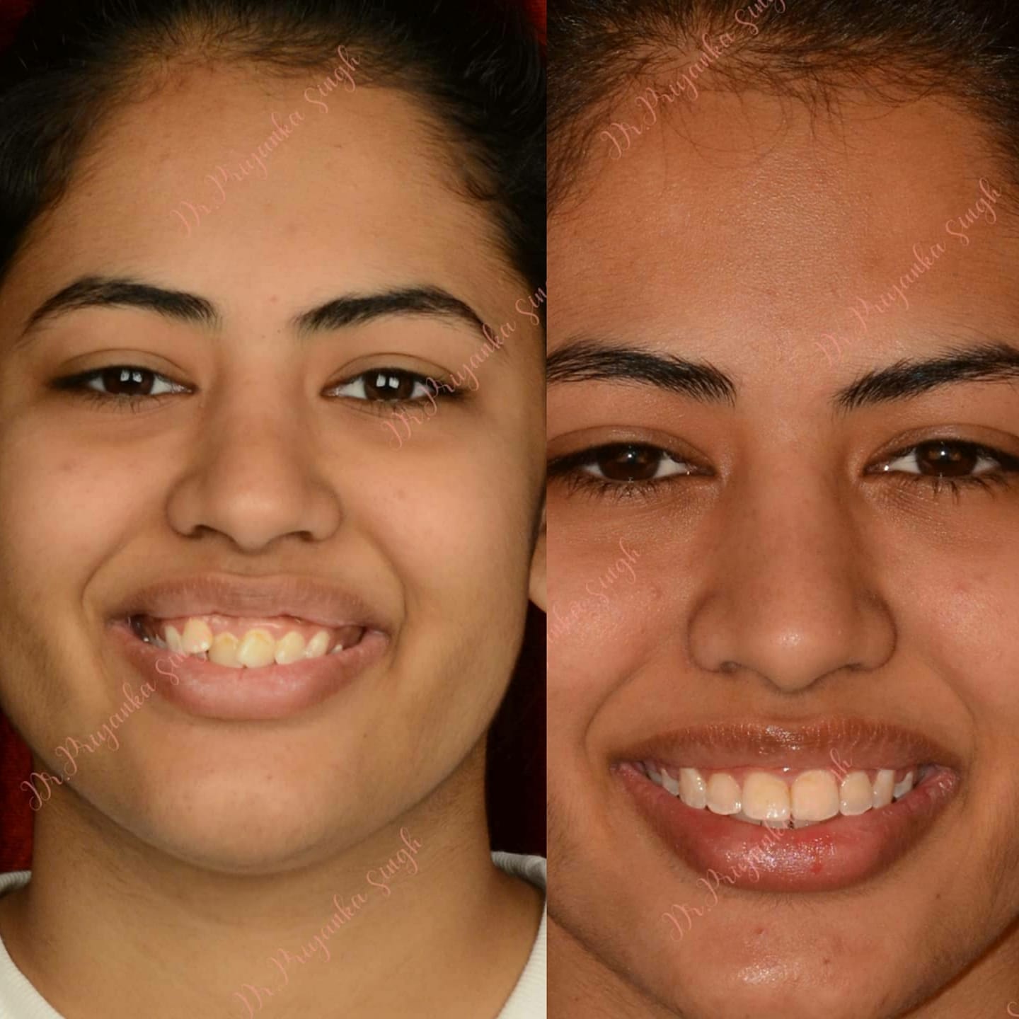 Before smile makeover