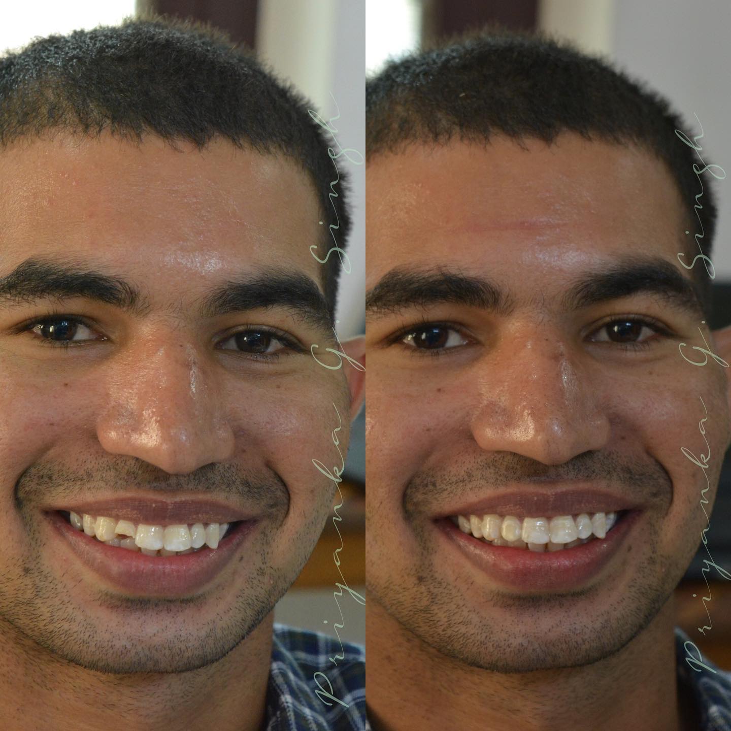 After smile makeover