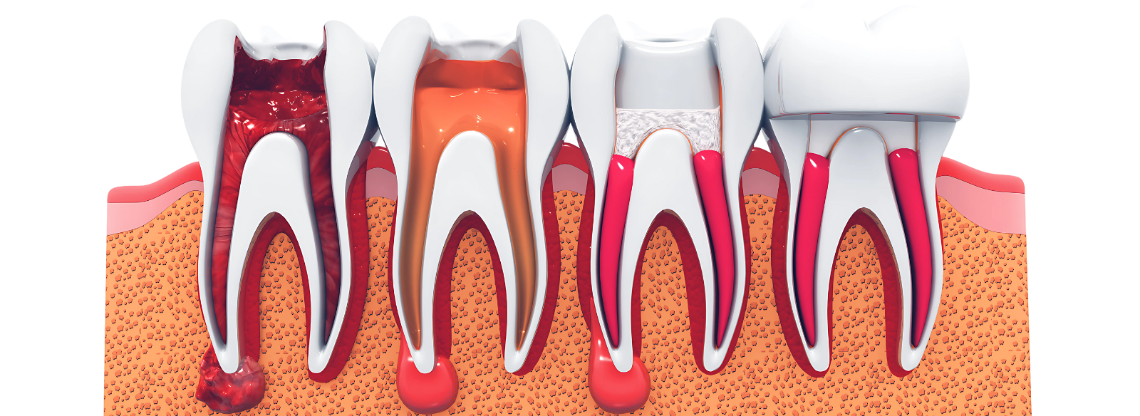 Root Canal Treatment Jaipur (1)