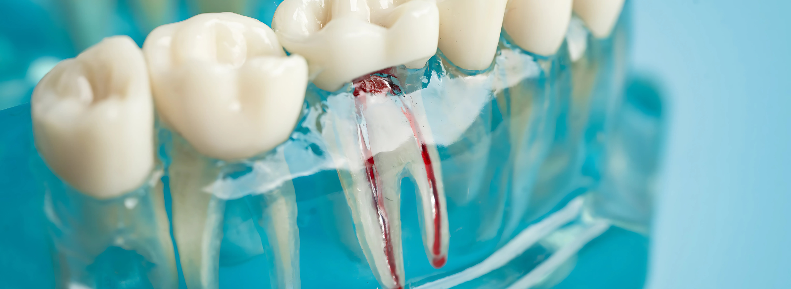 Root Canal Treatment in Jaipur